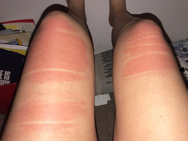 Don't wear ripped jeans in the sun.
