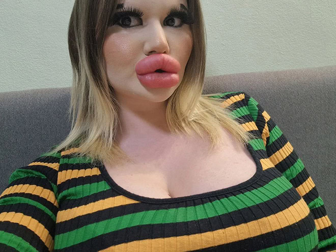 Overdone lip fillers.