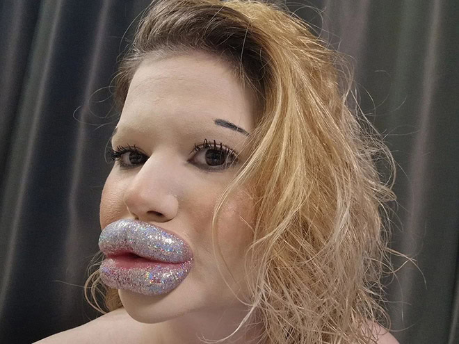 Overdone lip fillers.