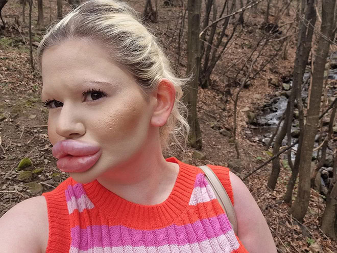 Overdone lip fillers.