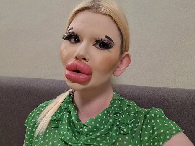 Overdone lip fillers.