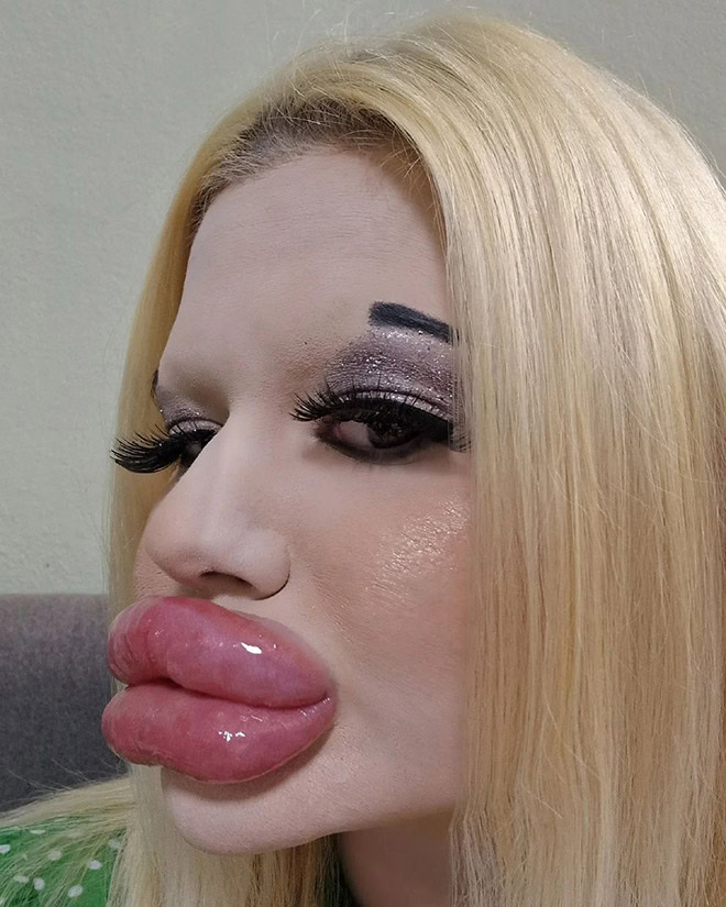 Overdone lip fillers.