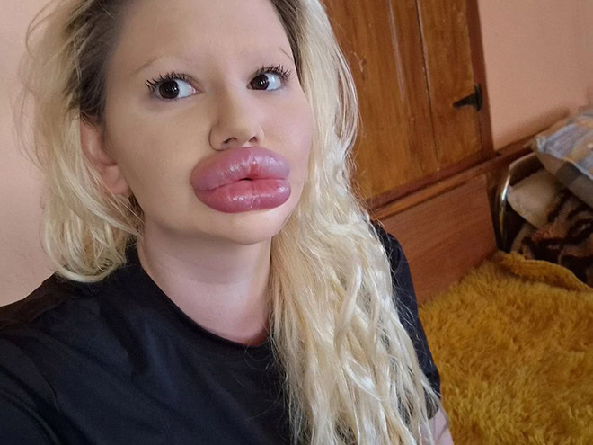 Overdone lip fillers.