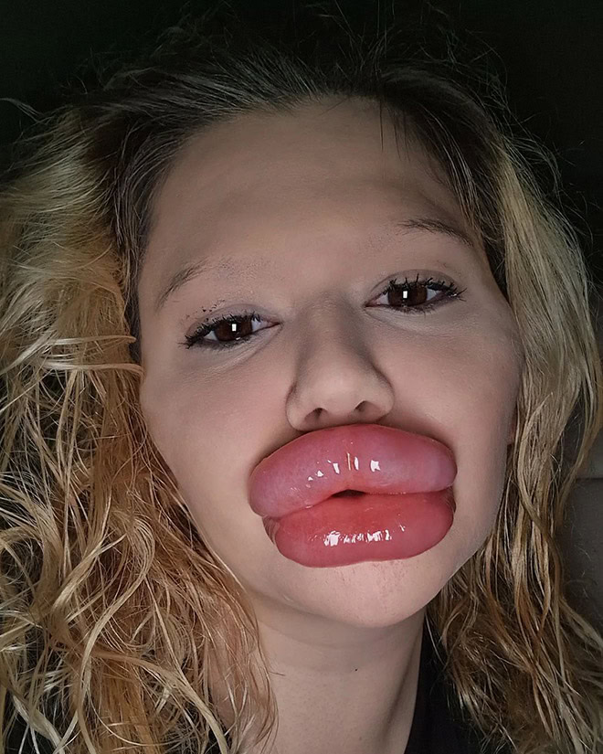 Overdone lip fillers.