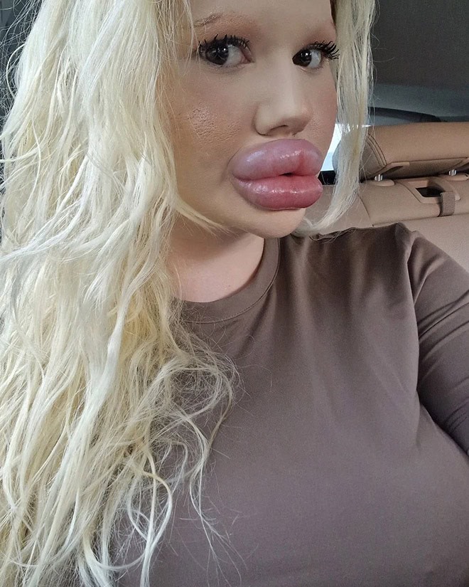 Overdone lip fillers.