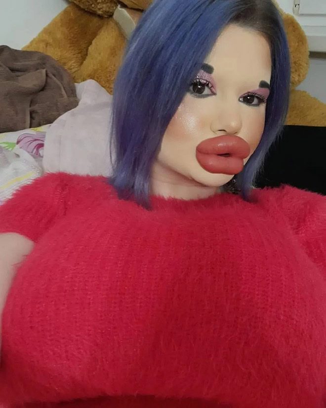 Overdone lip fillers.