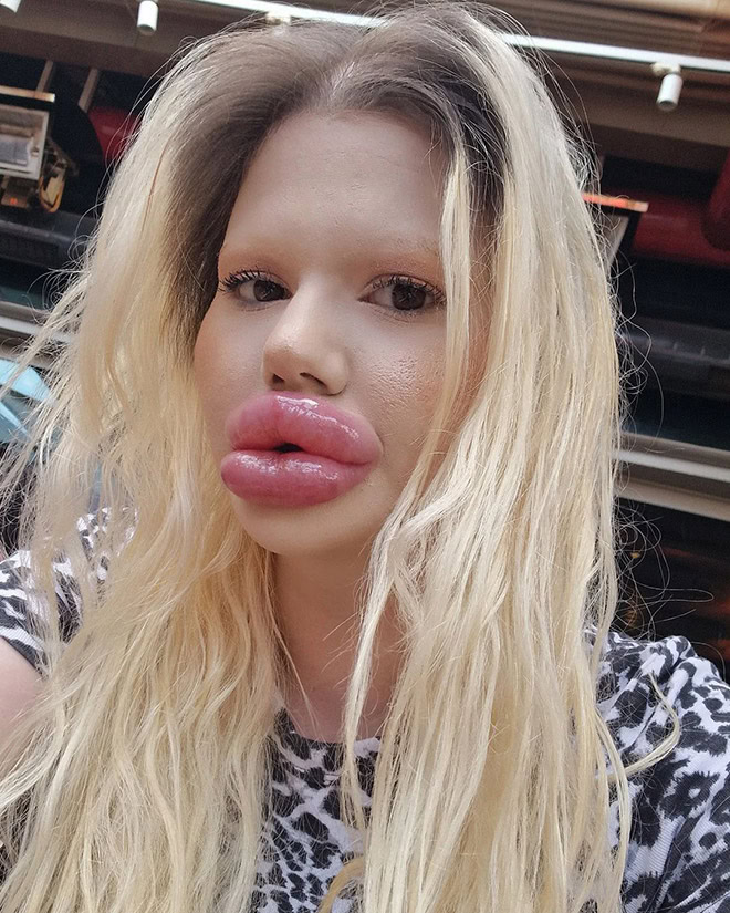 Overdone lip fillers.