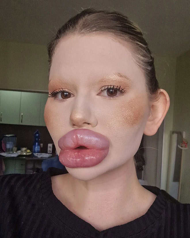 Overdone lip fillers.