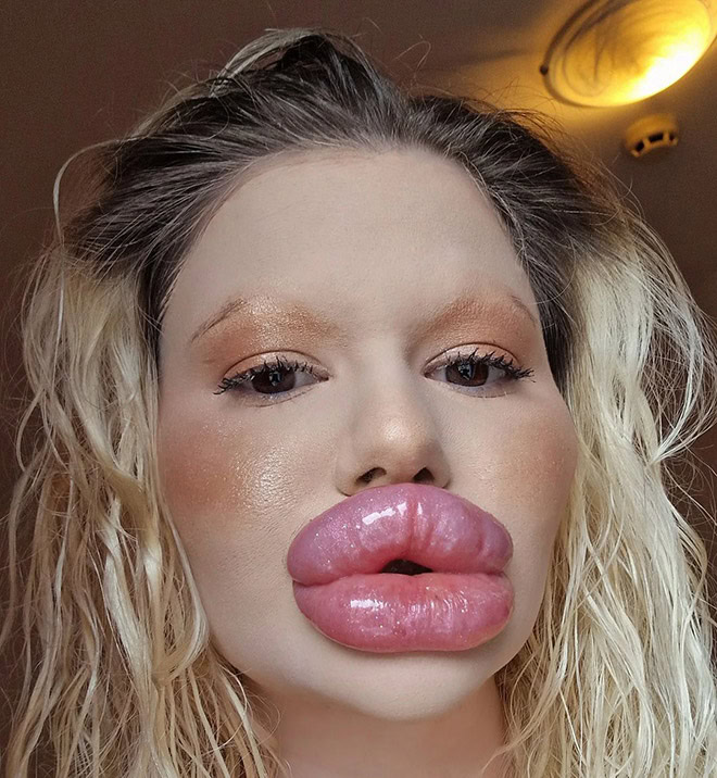 Overdone lip fillers.