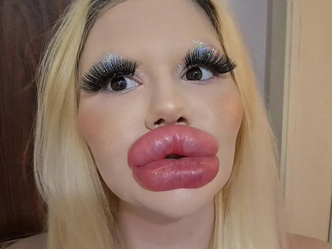 Overdone lip fillers.