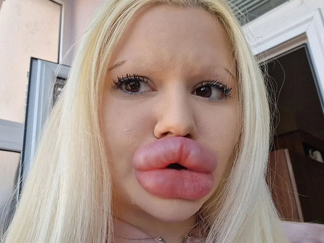 Overdone lip fillers.