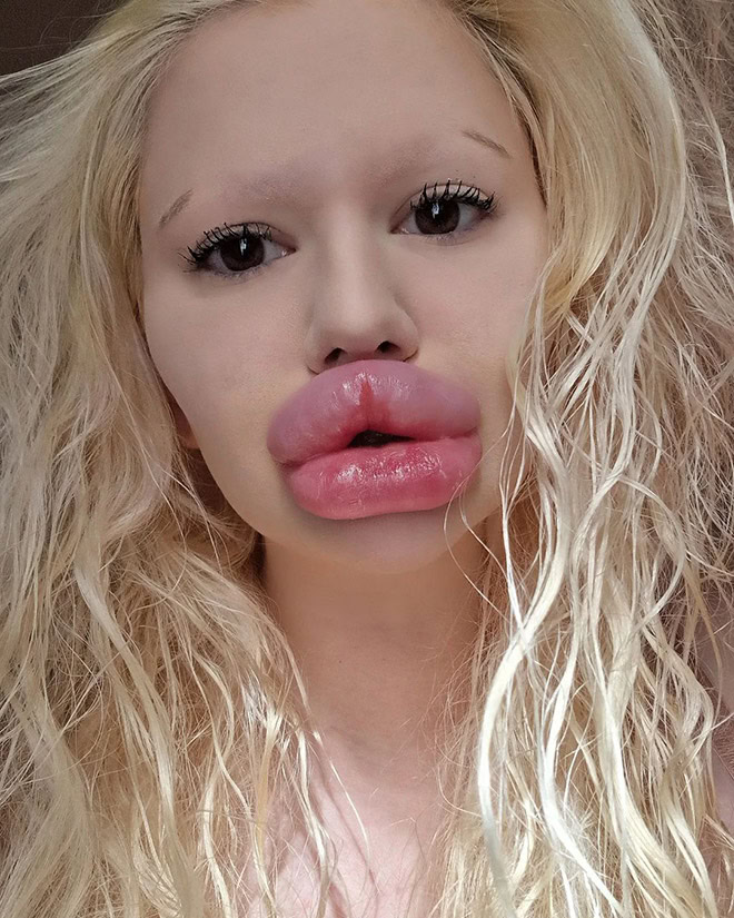 Overdone lip fillers.