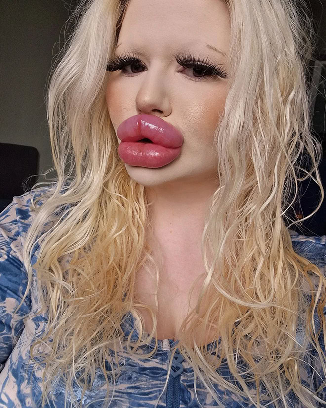 Overdone lip fillers.