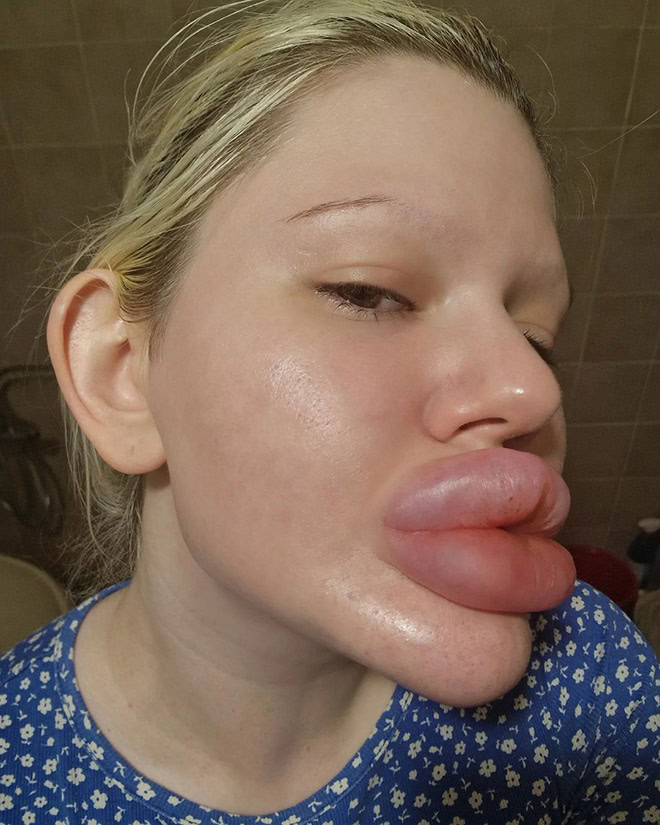 Overdone lip fillers.