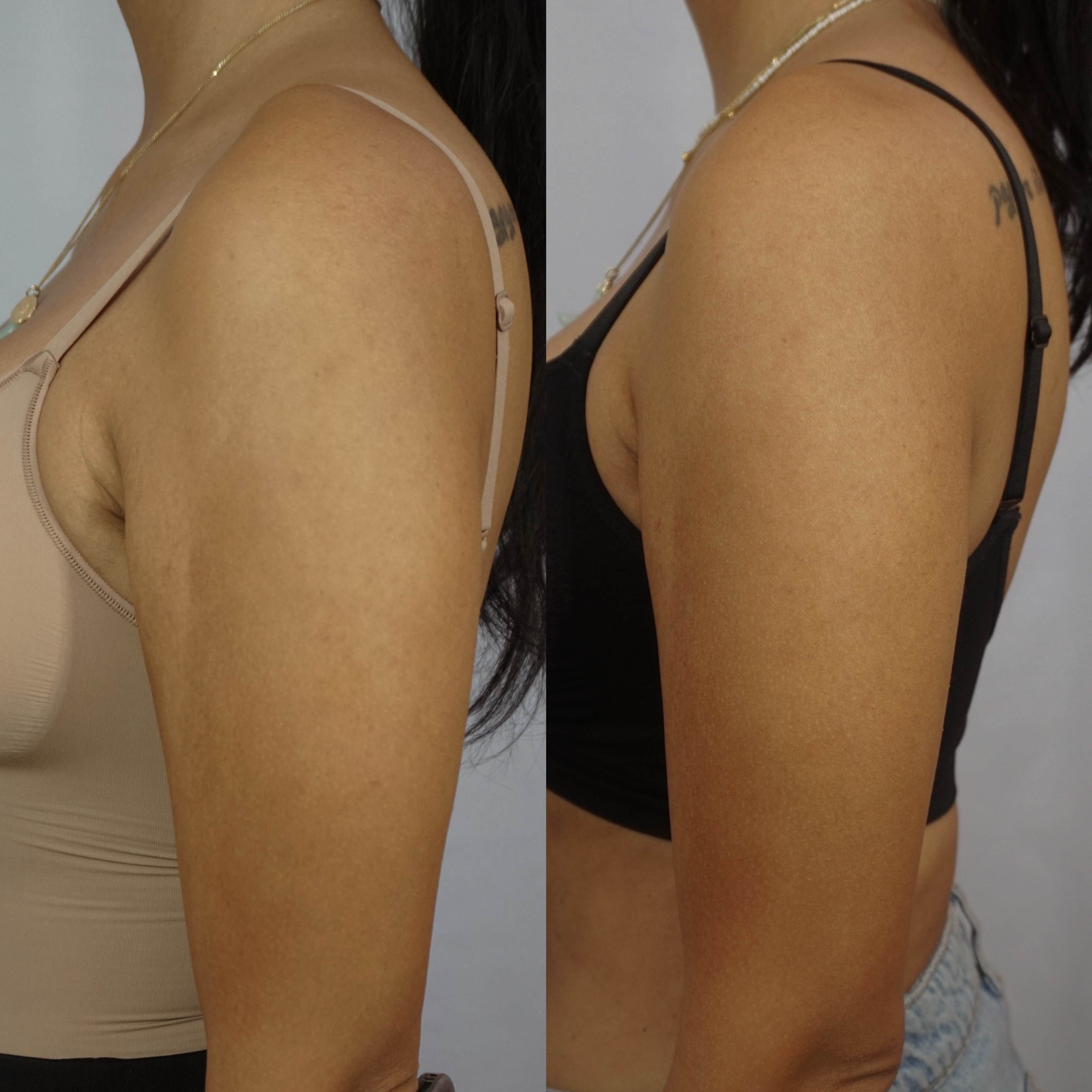 Before and after image of the arms after Onda Pro treatments